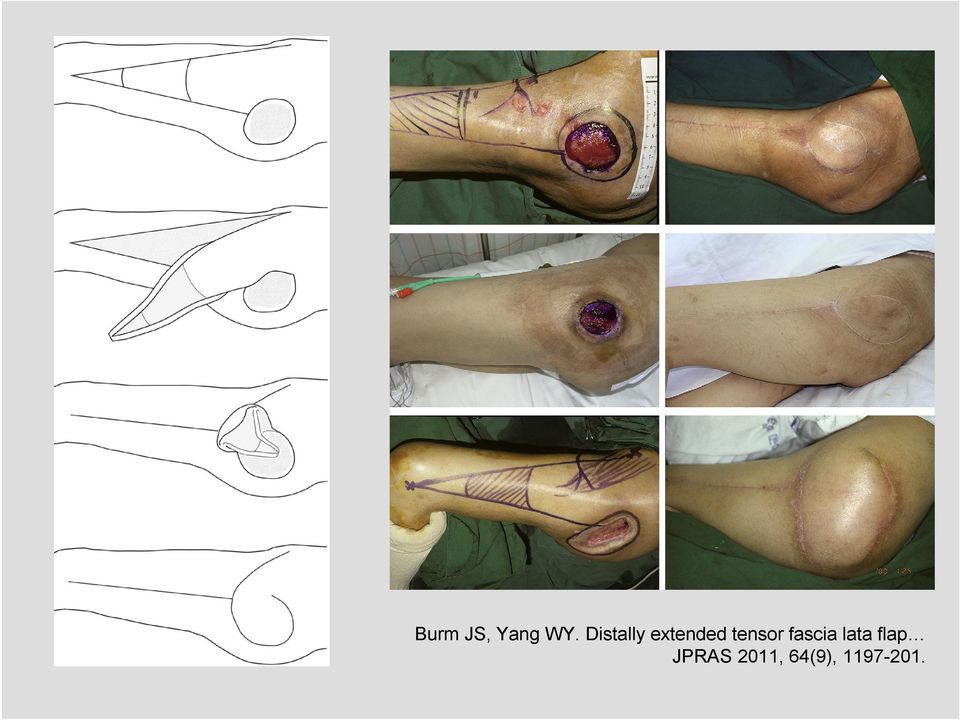 tensor fascia lata