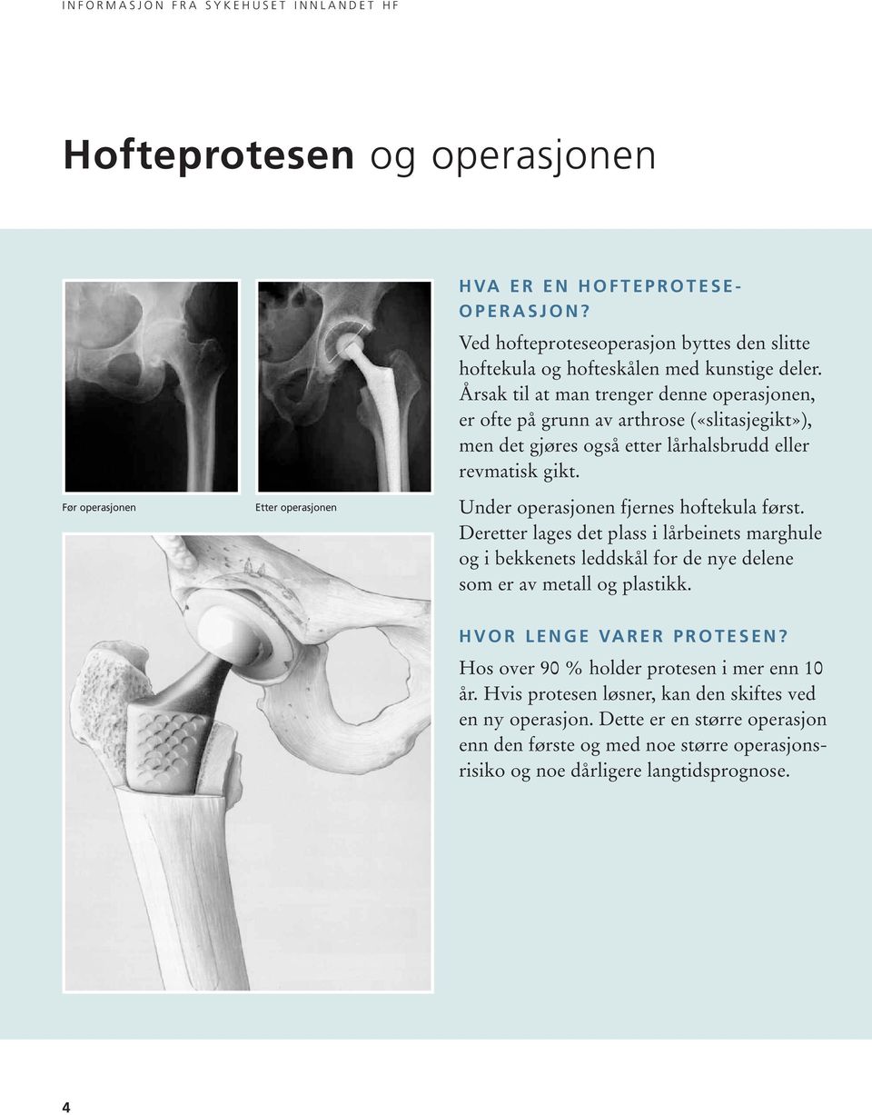 Årsak til at man tren ger denne operasjonen, er ofte på grunn av arthrose («slitasjegikt»), men det gjøres også etter lårhalsbrudd eller revmatisk gikt.