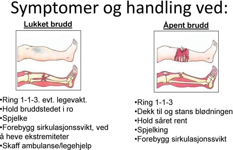 Hold bruddstedet i ro Spjelke Forebygg sirkulasjonssvikt, ved å heve