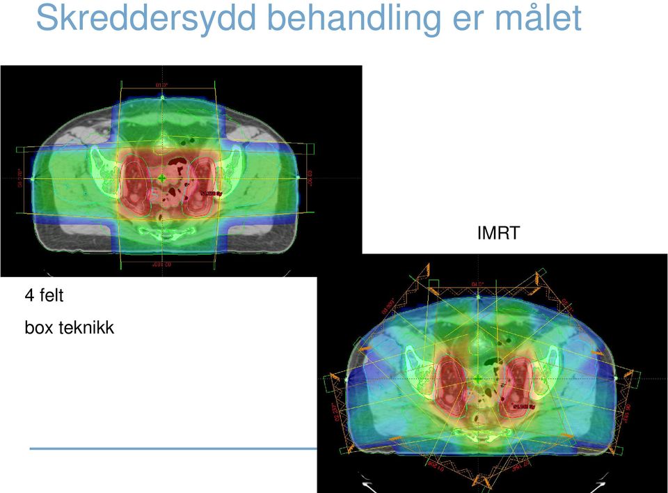 målet IMRT 4