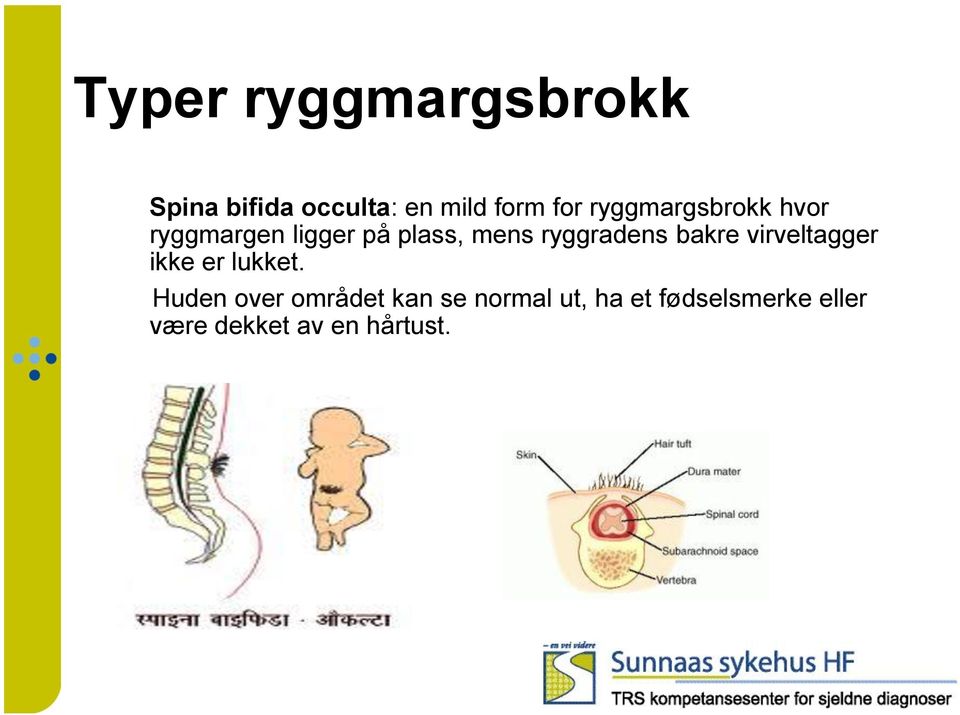 ryggradens bakre virveltagger ikke er lukket.