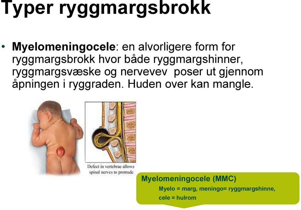 nervevev poser ut gjennom åpningen i ryggraden.