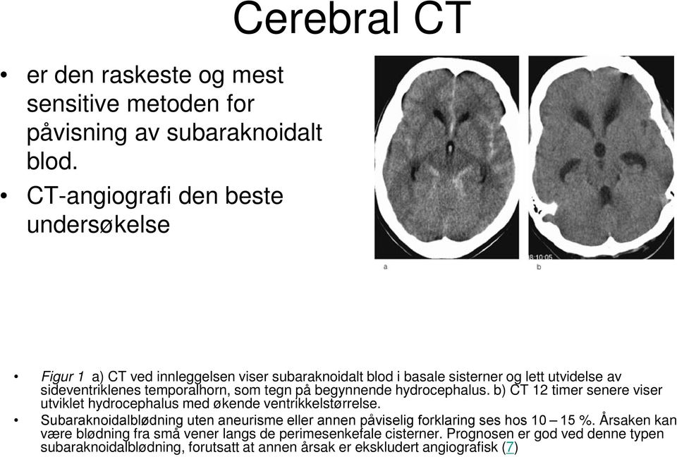 temporalhorn, som tegn på begynnende hydrocephalus. b) CT 12 timer senere viser utviklet hydrocephalus med økende ventrikkelstørrelse.