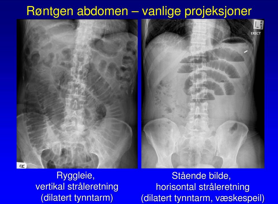 (dilatert tynntarm) Stående bilde,