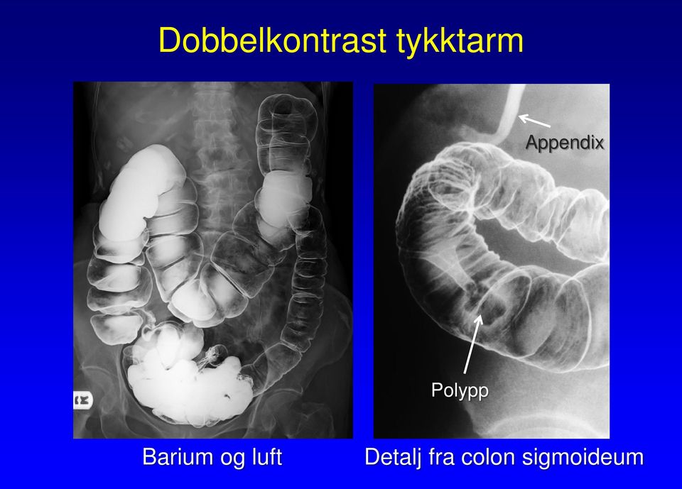 Polypp Barium og