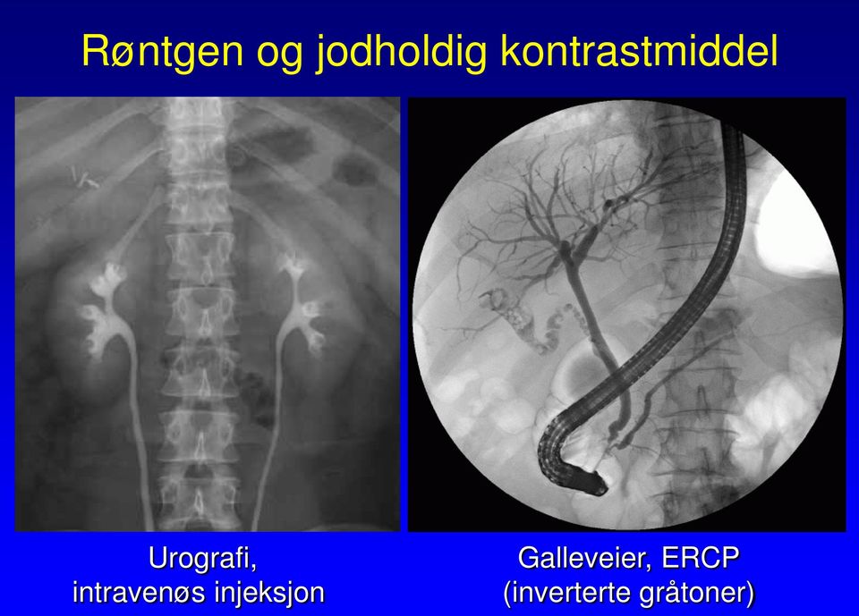 intravenøs injeksjon