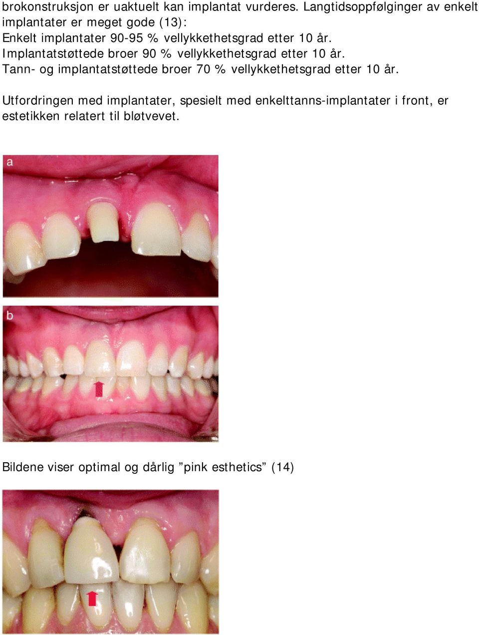 år. Implantatstøttede broer 90 % vellykkethetsgrad etter 10 år.
