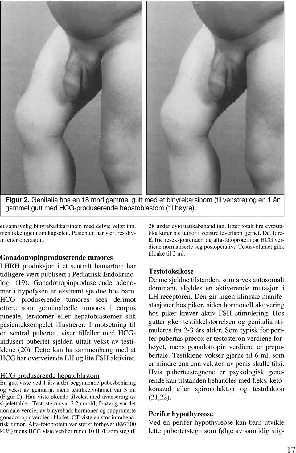 Gonadotropinproduserende tumores LHRH produksjon i et sentralt hamartom har tidligere vært publisert i Pediatrisk Endokrinologi (19).