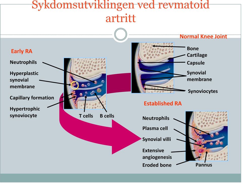 Hypertrophic synoviocyte T cells B cells Established RA Neutrophils Synovial