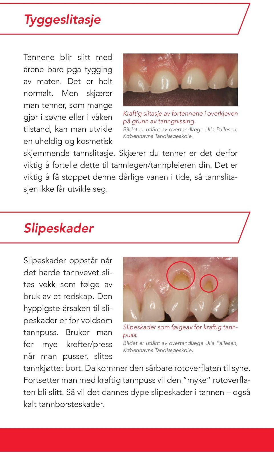 Bildet er utlånt av overtandlæge Ulla Pallesen, Københavns Tandlægeskole. skjemmende tannslitasje. Skjærer du tenner er det derfor viktig å fortelle dette til tannlegen/tannpleieren din.