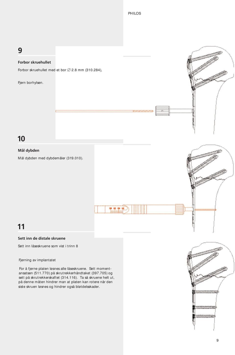 11 Sett inn de distale skruene Sett inn låseskruene som vist i trinn 8 Fjerning av implantatet For å fjerne platen løsnes alle