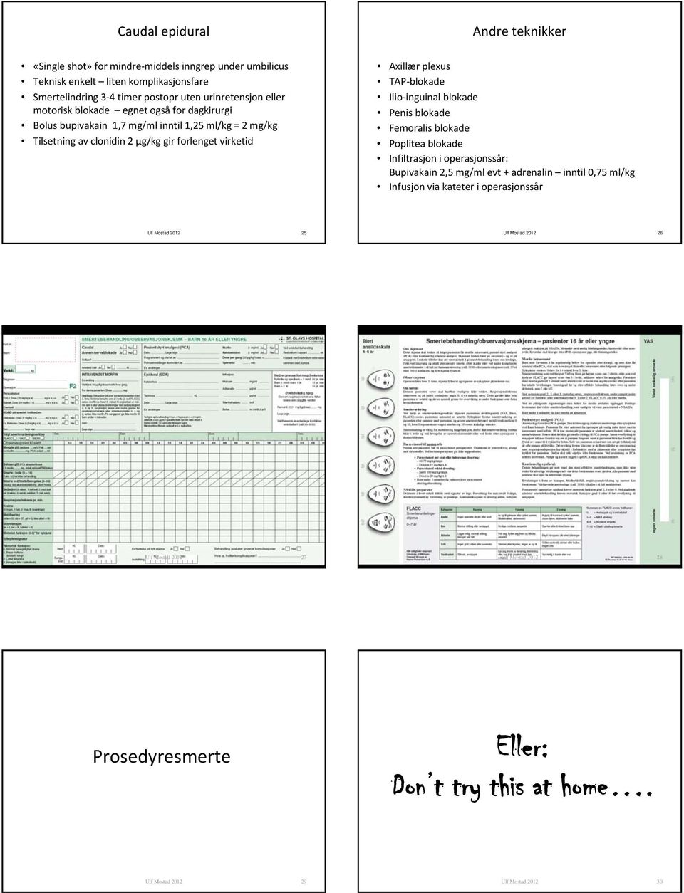 blokade Ilio inguinal blokade Penis blokade Femoralis blokade Poplitea blokade Infiltrasjon i operasjonssår: Bupivakain 2,5 mg/ml evt + adrenalin inntil 0,75 ml/kg Infusjon via