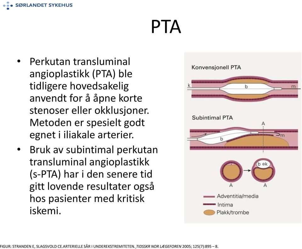 PTA Perkutan transluminal angioplastikk (PTA) ble tidligere hovedsakelig anvendt for å åpne korte stenoser
