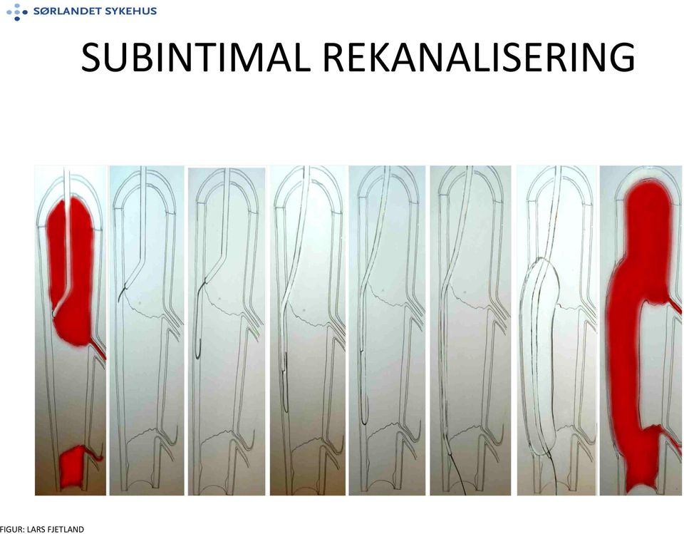 SUBINTIMAL