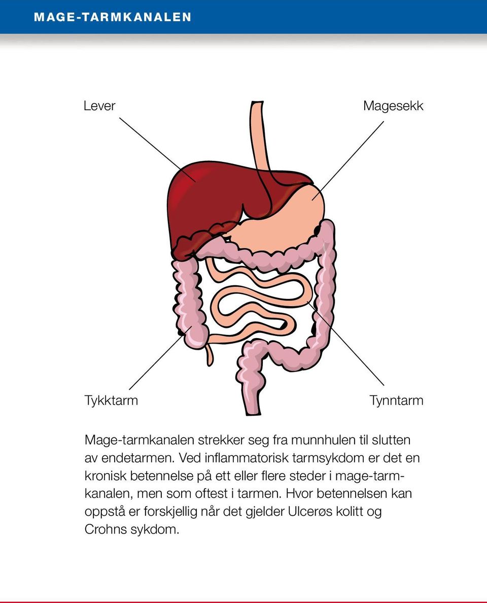 Ved inflammatorisk tarmsykdom er det en kronisk betennelse på ett eller flere steder