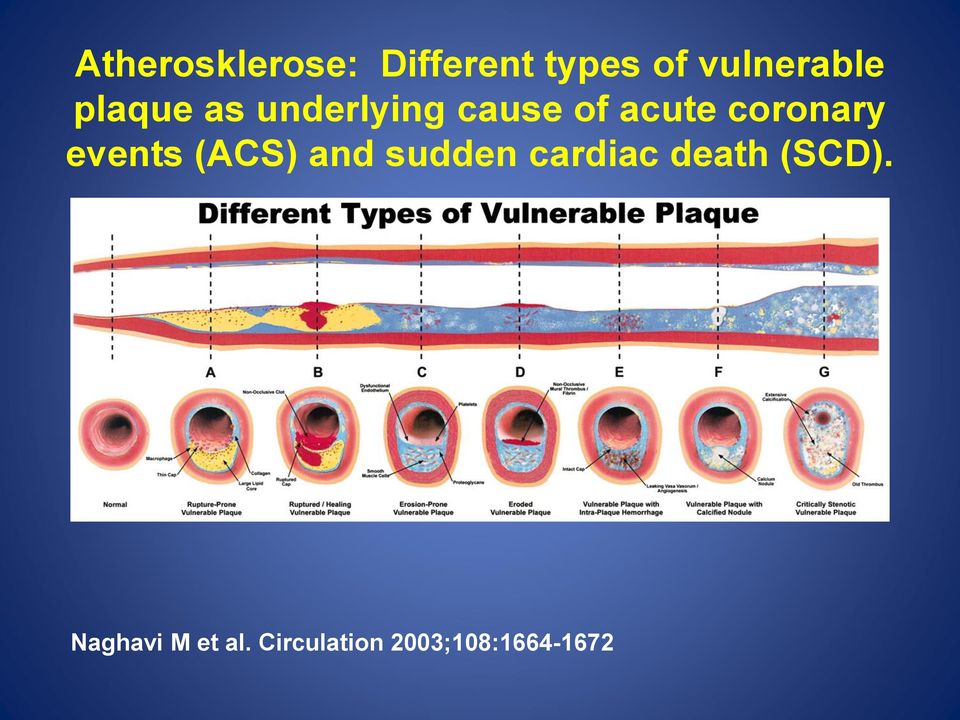 events (ACS) and sudden cardiac death (SCD).