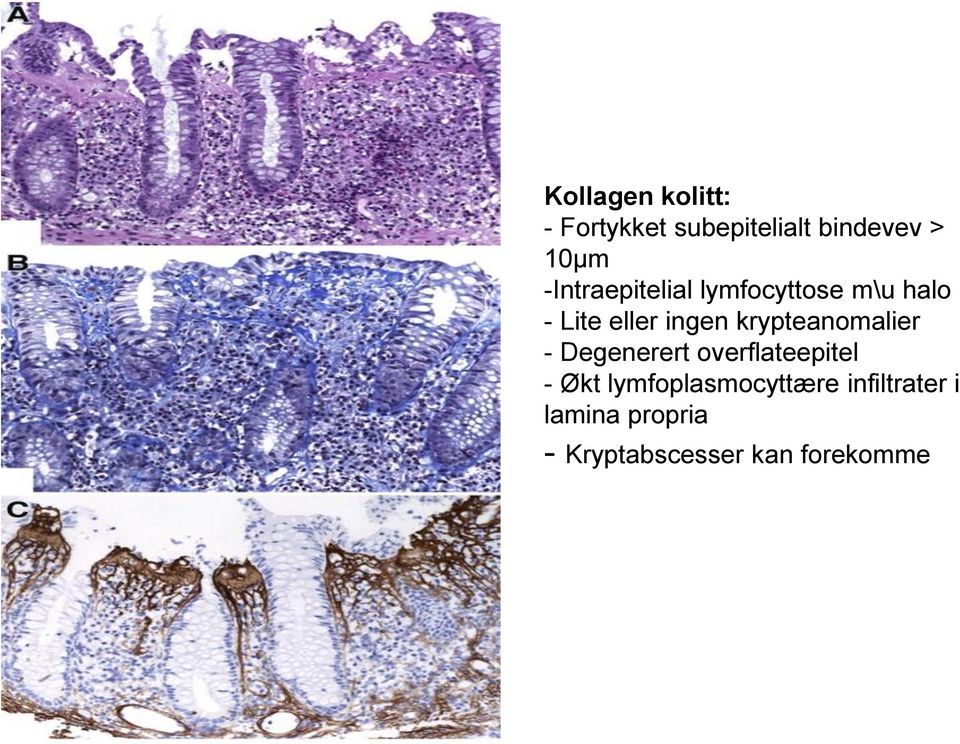 krypteanomalier - Degenerert overflateepitel - Økt