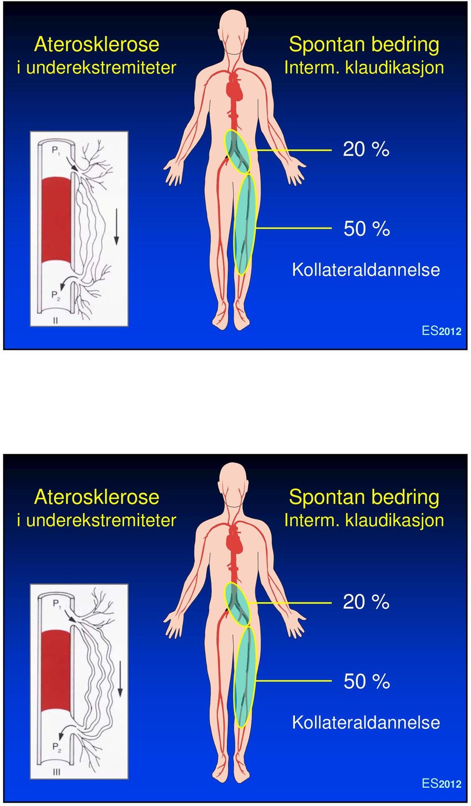 klaudikasjon 20 % 50 % Kollateraldannelse  