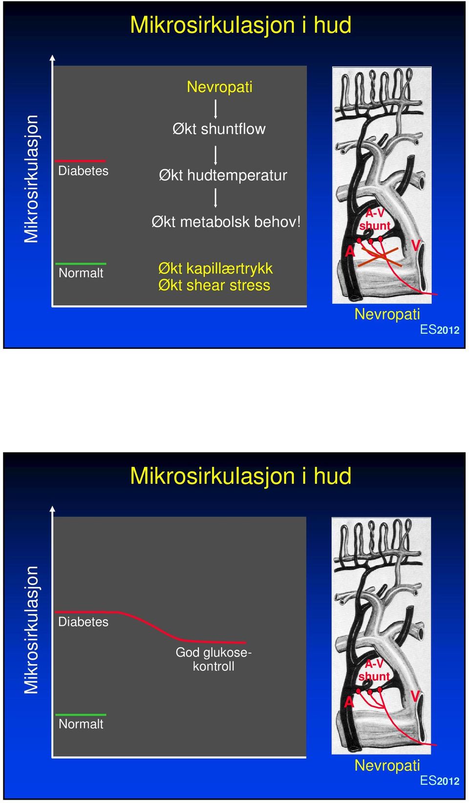 Økt kapillærtrykk Økt shear stress A A-V shunt V Nevropati