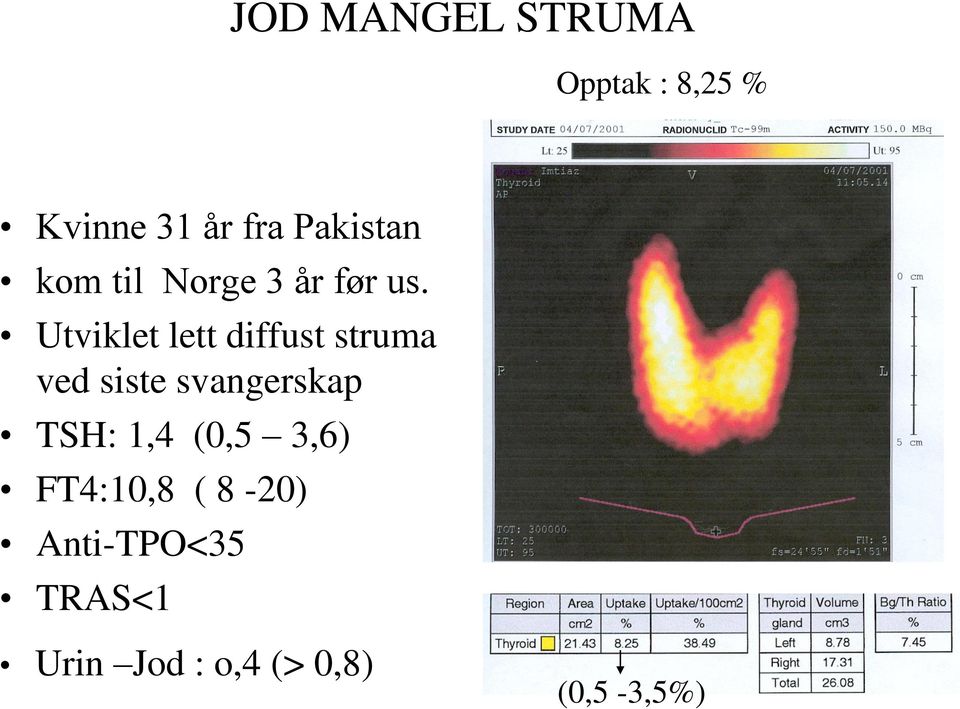 Utviklet lett diffust struma ved siste svangerskap TSH: