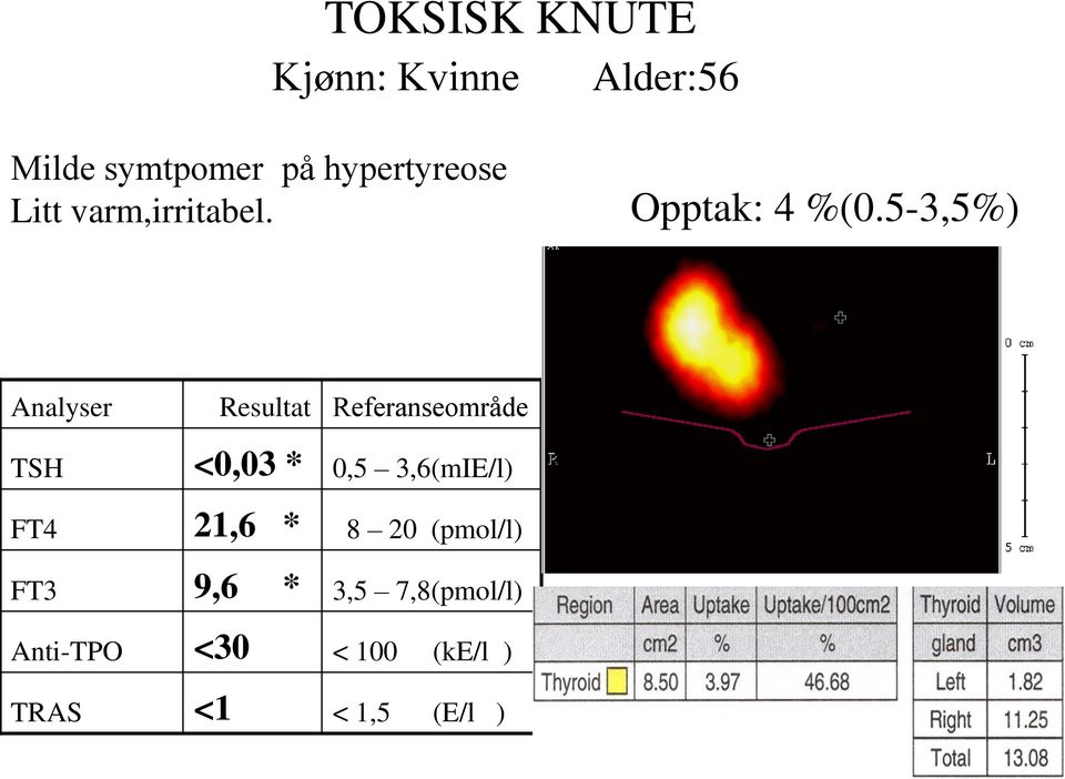 5-3,5%) Analyser TSH FT4 FT3 Anti-TPO TRAS Resultat <0,03 * 21,6 * 9,6 *