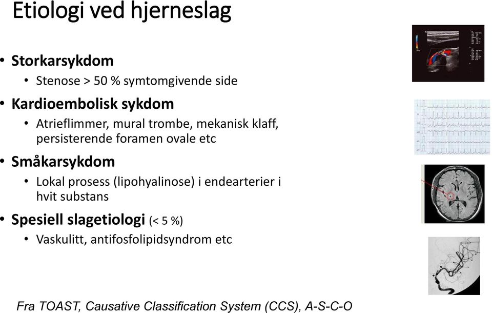 Småkarsykdom Lokal prosess (lipohyalinose) i endearterier i hvit substans Spesiell