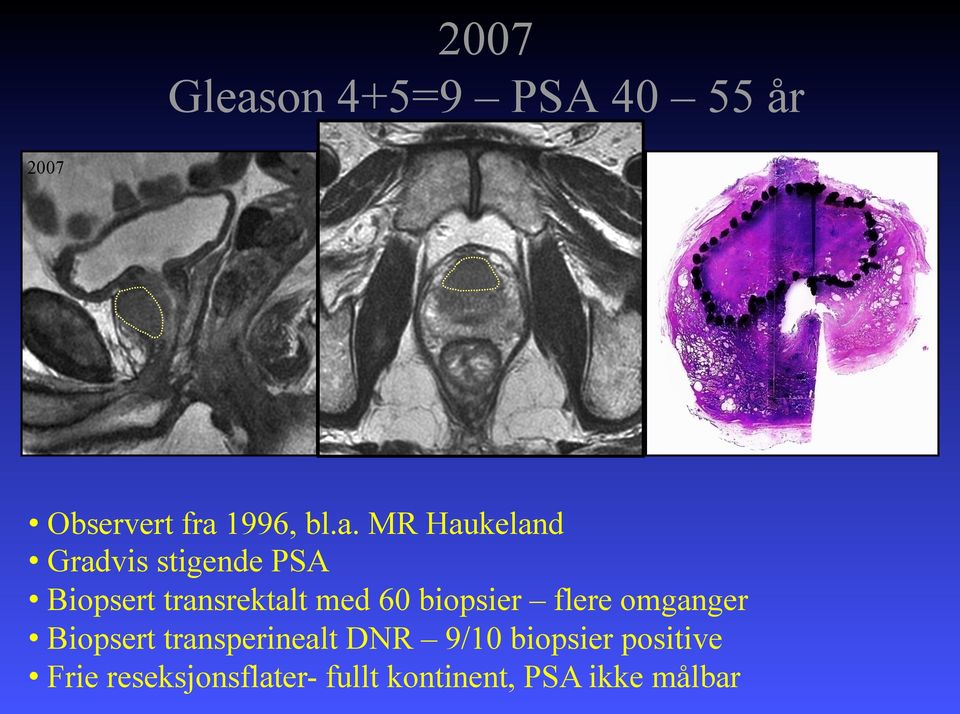 biopsier flere omganger Biopsert transperinealt DNR 9/10 biopsier