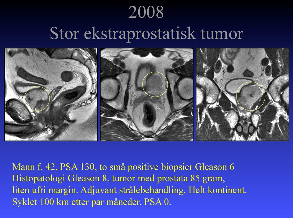 Histopatologi Gleason 8, tumor med prostata 85 gram, liten