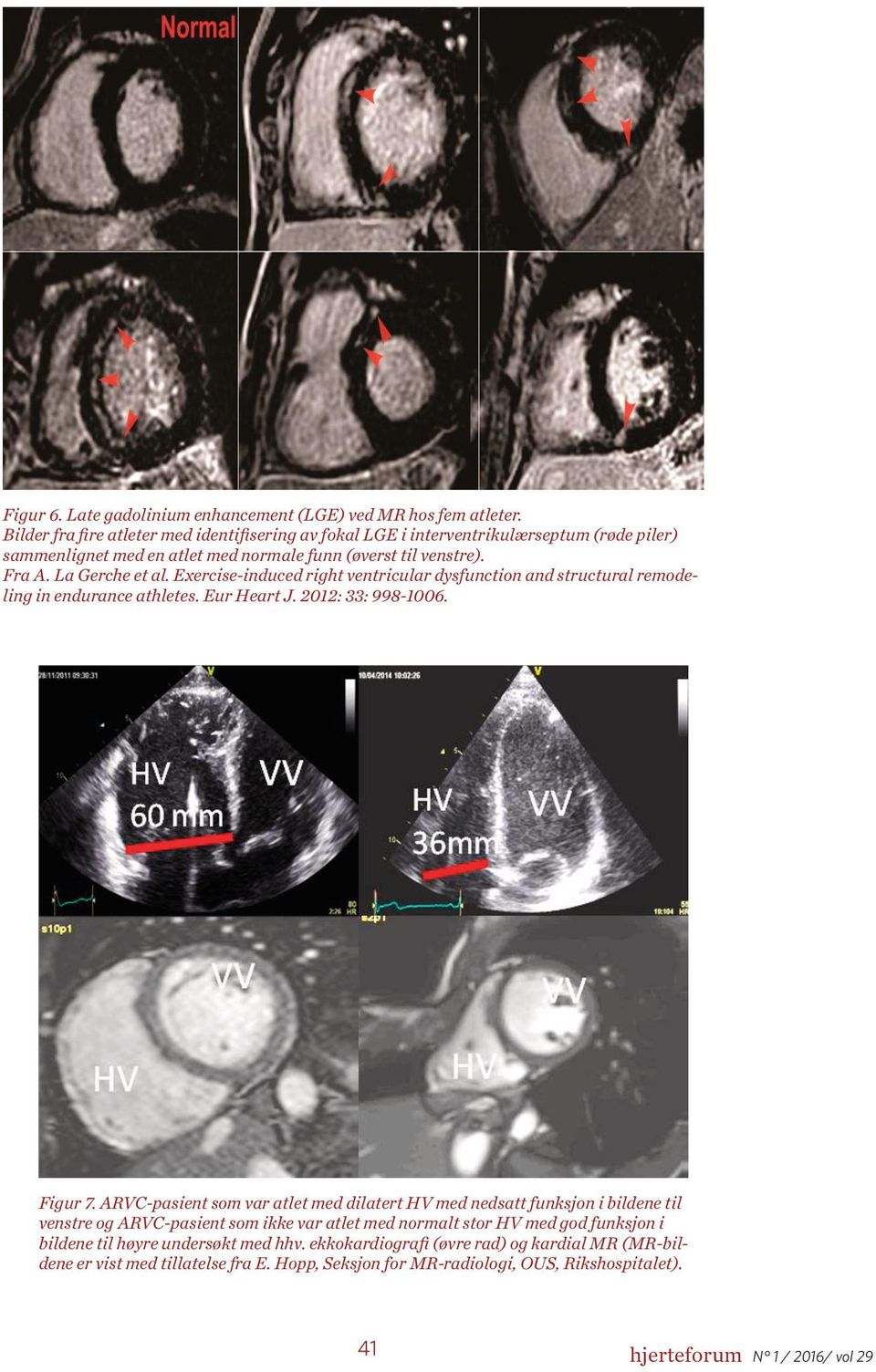 Exercise-induced right ventricular dysfunction and structural remodeling in endurance athletes. Eur Heart J. 2012: 33: 998-1006. Figur 7.