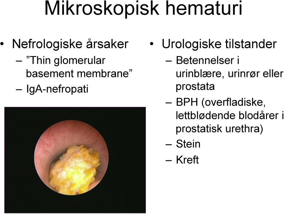 Betennelser i urinblære, urinrør eller prostata BPH