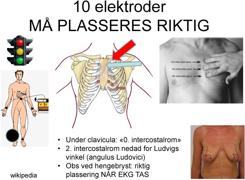 intercostalrom nedad for Ludvigs vinkel