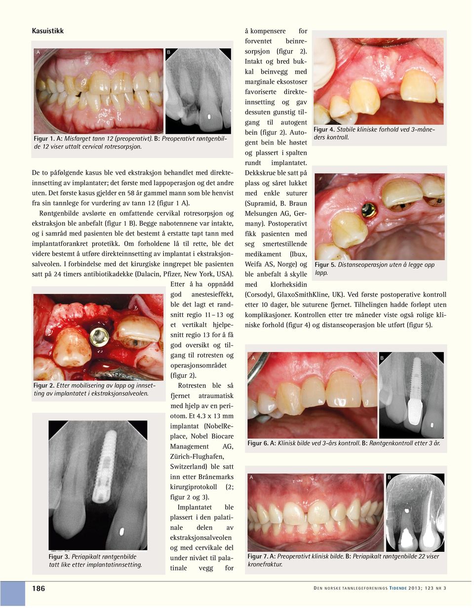 Det første kasus gjelder en 58 år gammel mann som ble henvist fra sin tannlege for vurdering av tann 12 (figur 1 A).