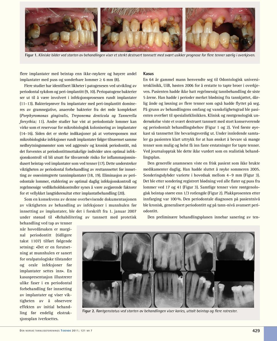Flere studier har identifisert likheter i patogenesen ved utvikling av periodontal sykdom og peri-implantitt (9, 10).