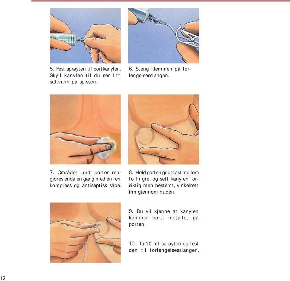 Området rundt porten rengjøres enda en gang med en ren kompress og antiseptisk såpe. 8.