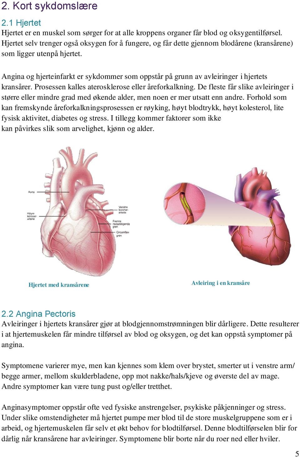 Angina og hjerteinfarkt er sykdommer som oppstår på grunn av avleiringer i hjertets kransårer. Prosessen kalles aterosklerose eller åreforkalkning.
