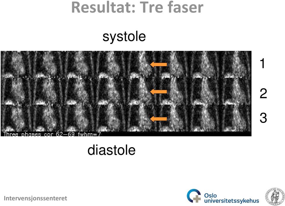 systole 1