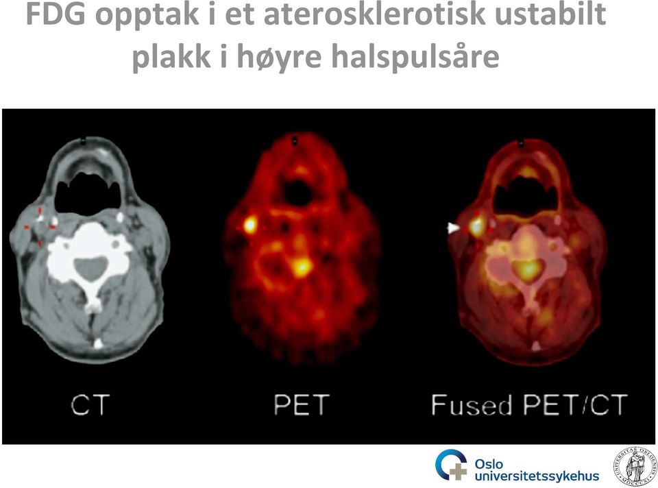 ustabilt plakk i