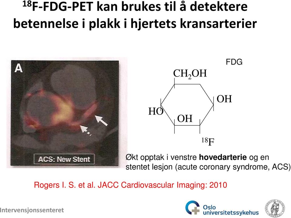 venstre hovedarterie og en stentet lesjon (acute coronary