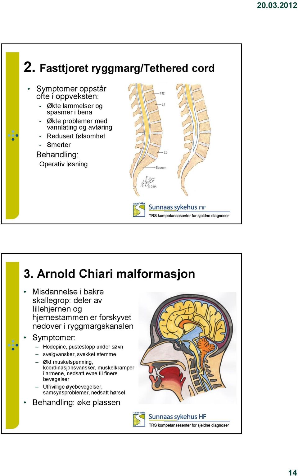 Arnold Chiari malformasjon Misdannelse i bakre skallegrop: deler av lillehjernen og hjernestammen er forskyvet nedover i ryggmargskanalen Symptomer: