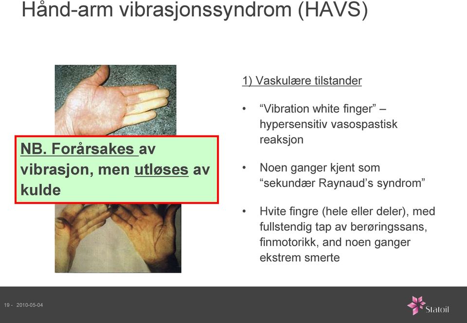 vasospastisk reaksjon Noen ganger kjent som sekundær Raynaud s syndrom Hvite fingre