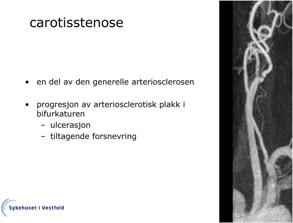 progresjon av arteriosclerotisk