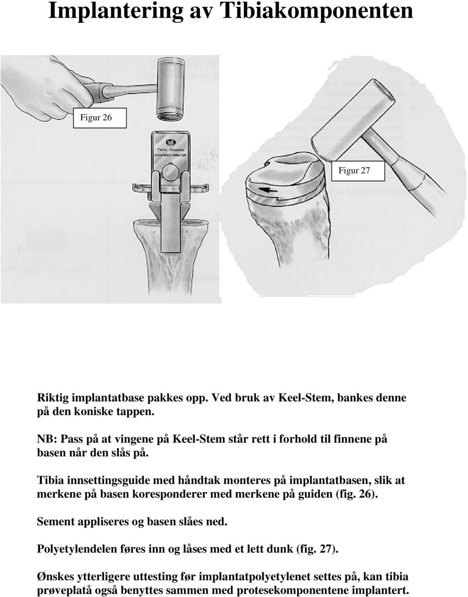 Tibia innsettingsguide med håndtak monteres på implantatbasen, slik at merkene på basen koresponderer med merkene på guiden (fig. 26).