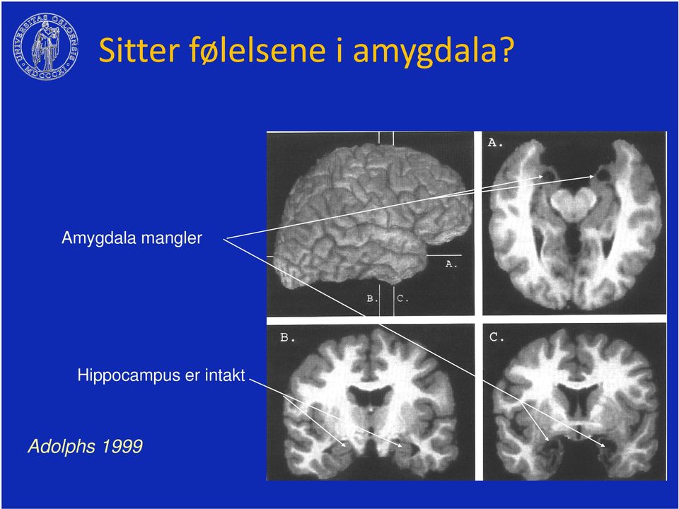 Amygdala mangler