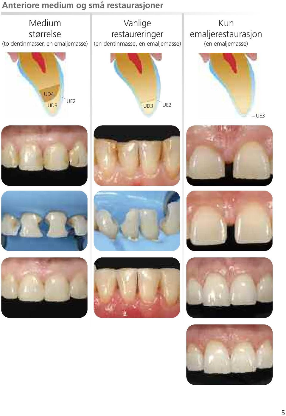 Vanlige restaureringer (en dentinmasse, en