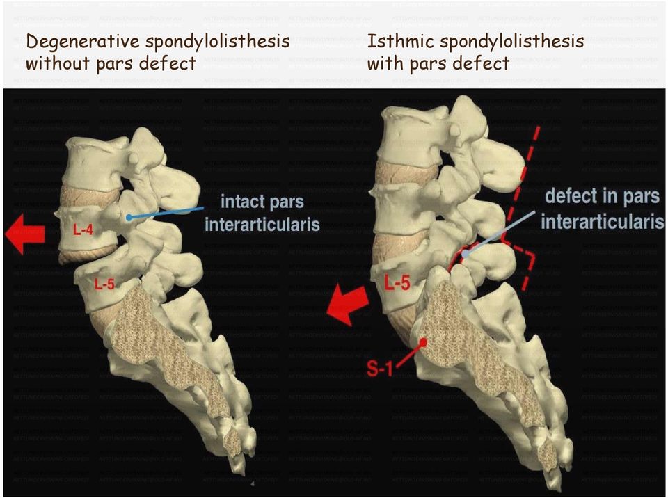 pars defect Isthmic