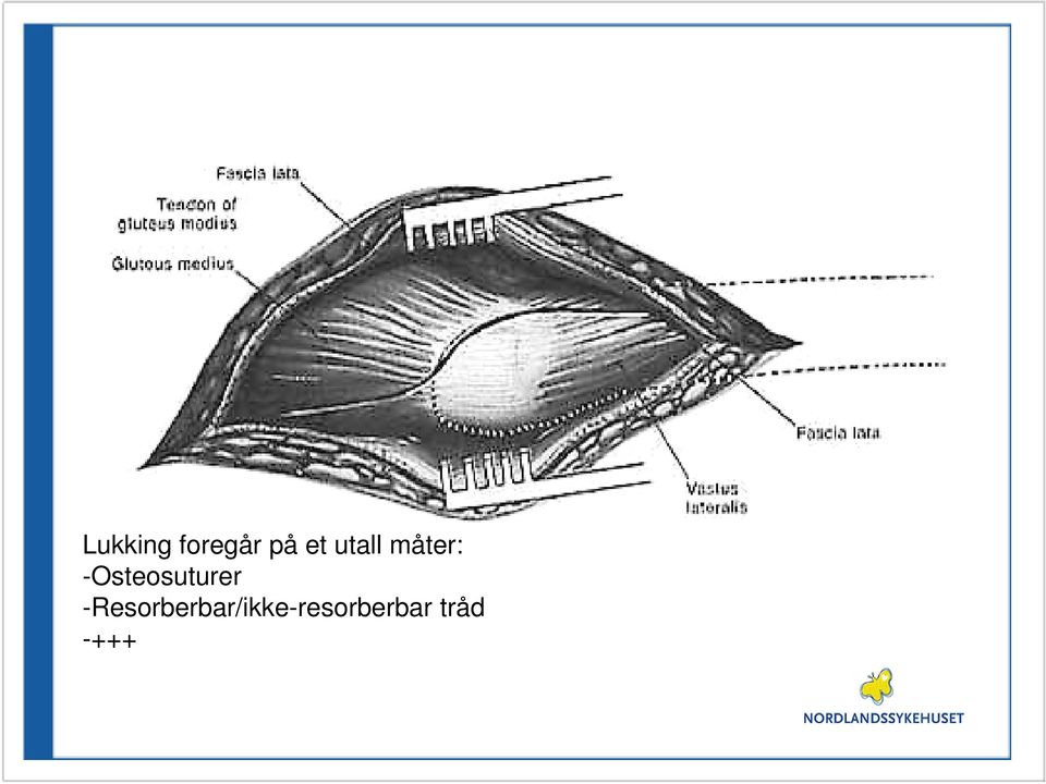 -Osteosuturer