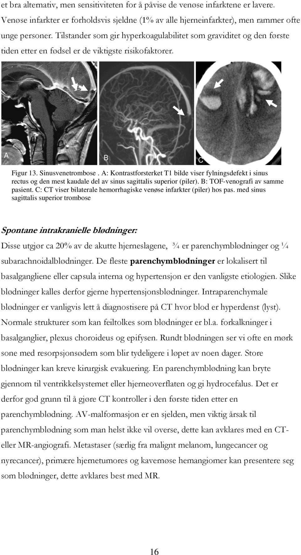 A: Kontrastforsterket T1 bilde viser fylningsdefekt i sinus rectus og den mest kaudale del av sinus sagittalis superior (piler). B: TOF-venografi av samme pasient.
