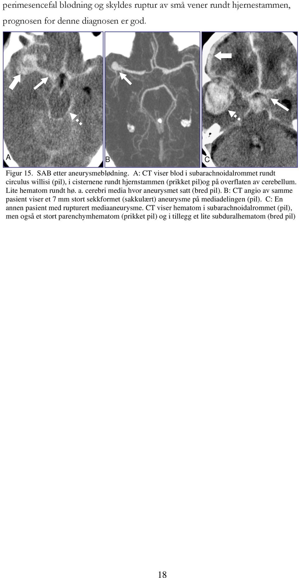 a. cerebri media hvor aneurysmet satt (bred pil). B: CT angio av samme pasient viser et 7 mm stort sekkformet (sakkulært) aneurysme på mediadelingen (pil).