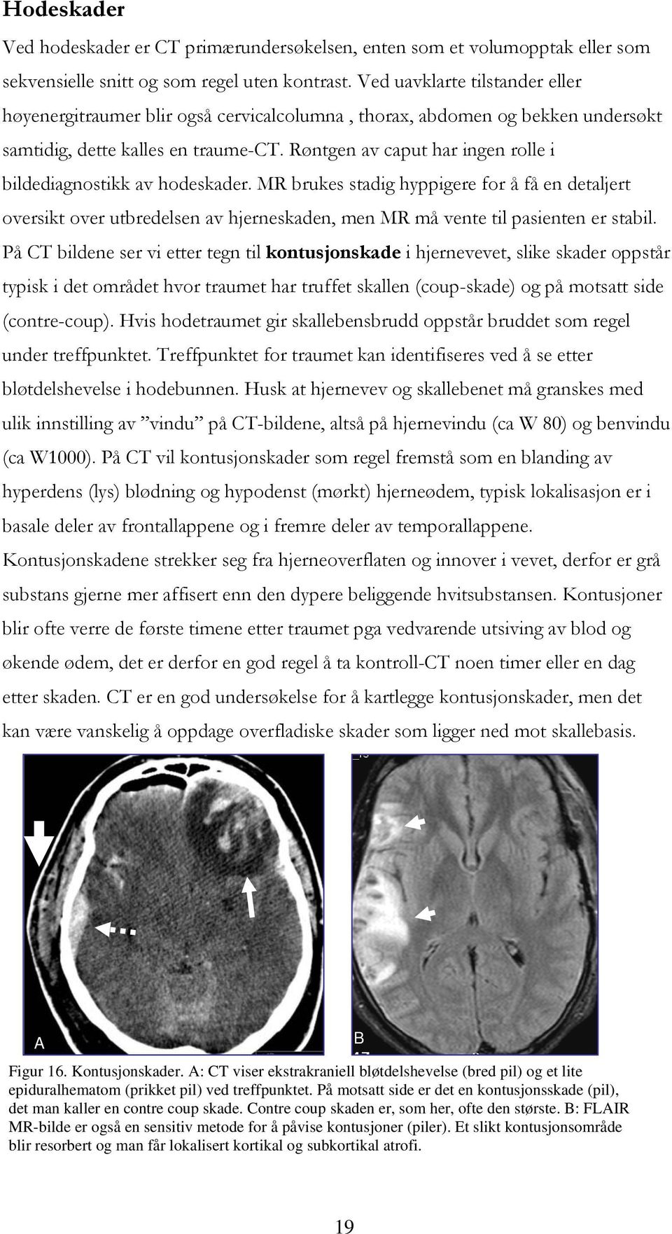 Røntgen av caput har ingen rolle i bildediagnostikk av hodeskader. MR brukes stadig hyppigere for å få en detaljert oversikt over utbredelsen av hjerneskaden, men MR må vente til pasienten er stabil.