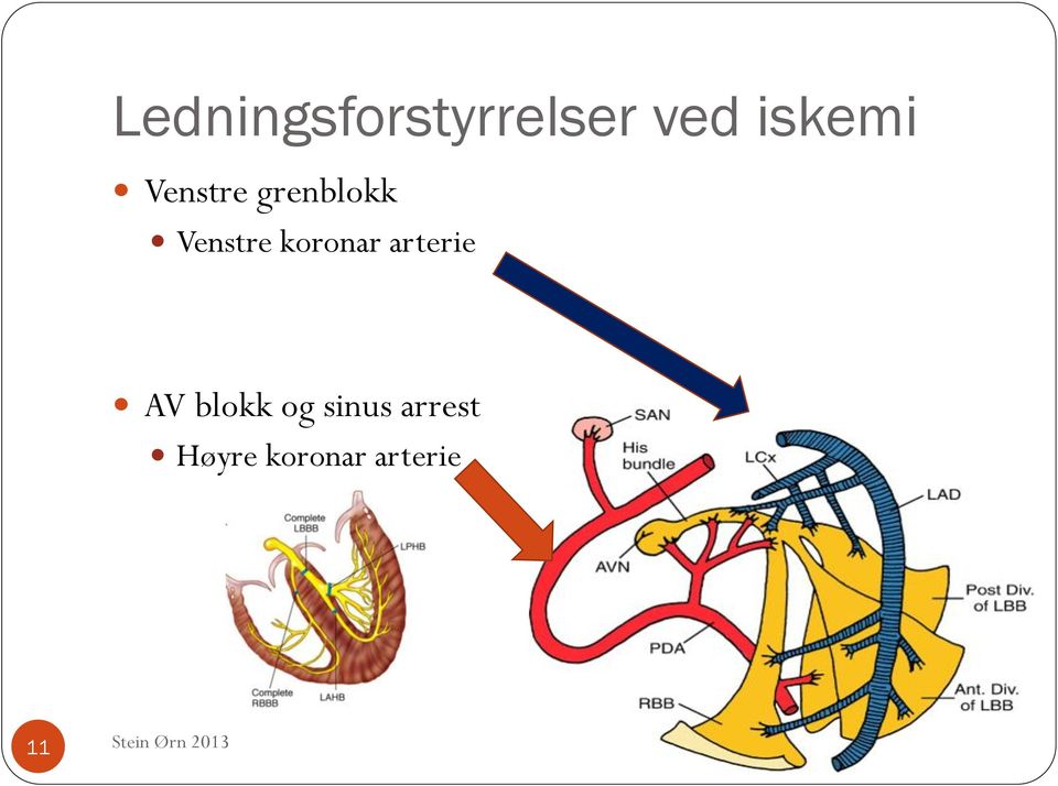 Venstre koronar arterie AV